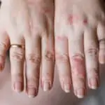 Woman's hands with a laundry detergent rash