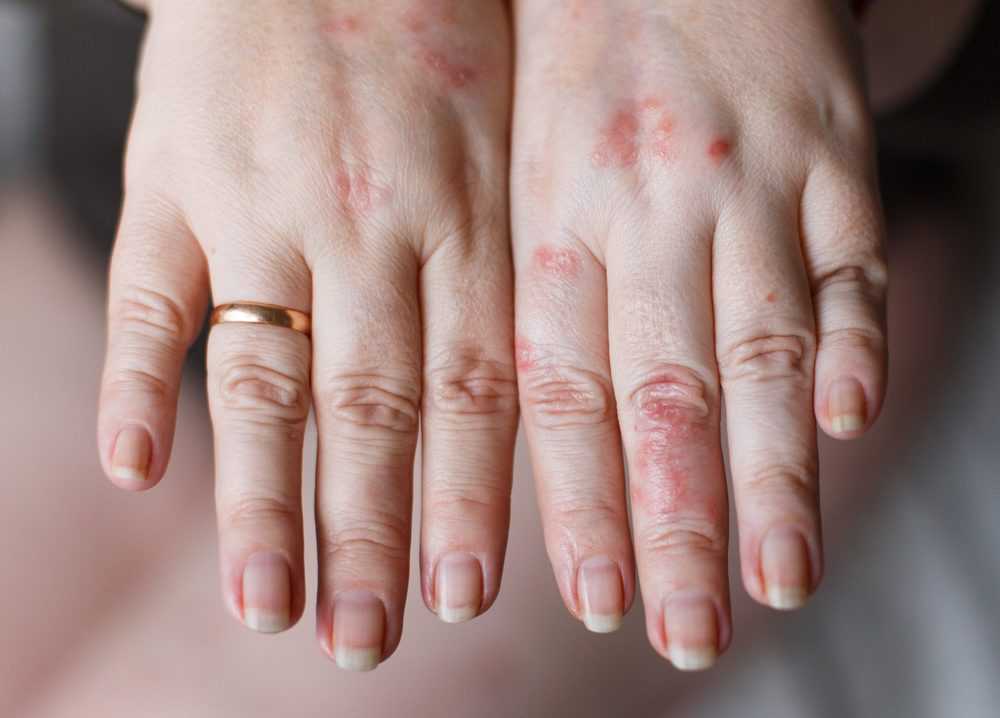 Woman's hands with a laundry detergent rash